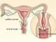 Hlavné príčiny erózie krčka maternice u nulipariek Eróziu môžete kauterizovať u nulipar